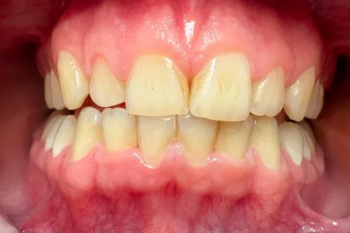 Stav zubů před dentální hygienou