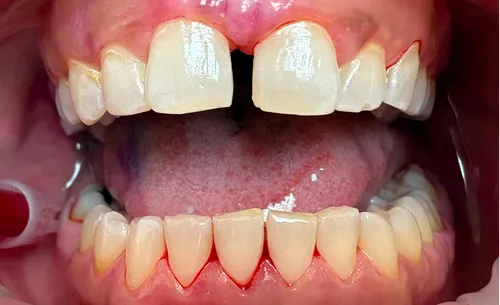 Výsledek dentální hygieny - po ošetření