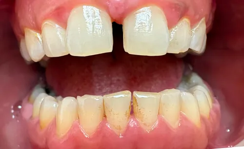 Stav zubů před dentální hygienou